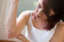 eczema